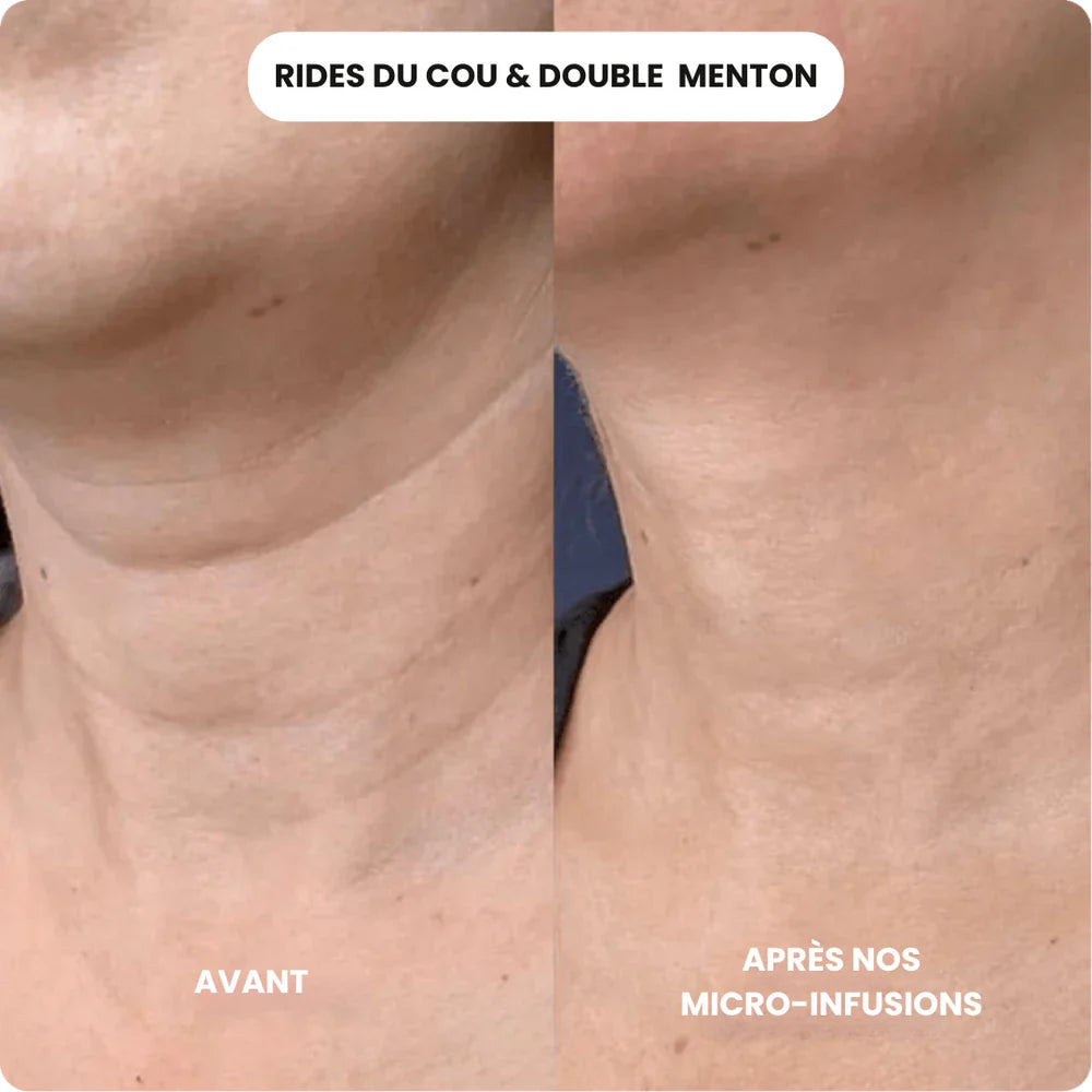 Micro-infusion anti-âge