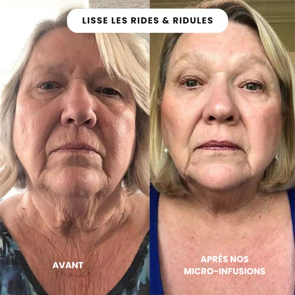 Micro-infusion anti-âge